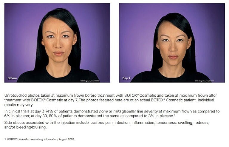 Botox Injection Before & After Photos