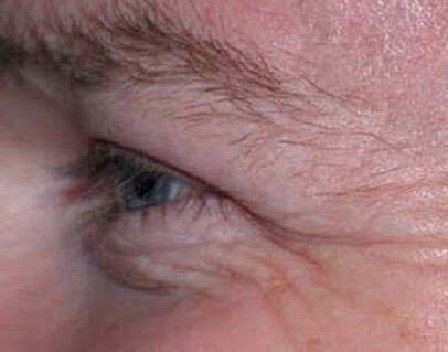 BOTOX Injection for the Wrinkles Around Your Eyes (Crow’s Feet)