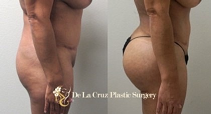 Before and after body transformation surgery showcase.