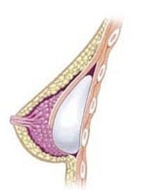 Breast Implant Placement: Above or Below the Muscle?