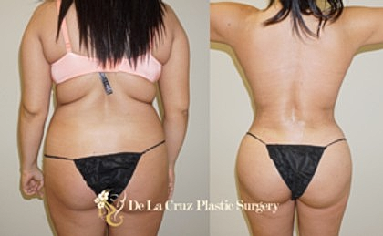 Busting The Myths About Liposuction Houston Services