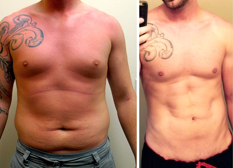 Defining your Six-packs Abs with Hi-Def VASER Liposuction
