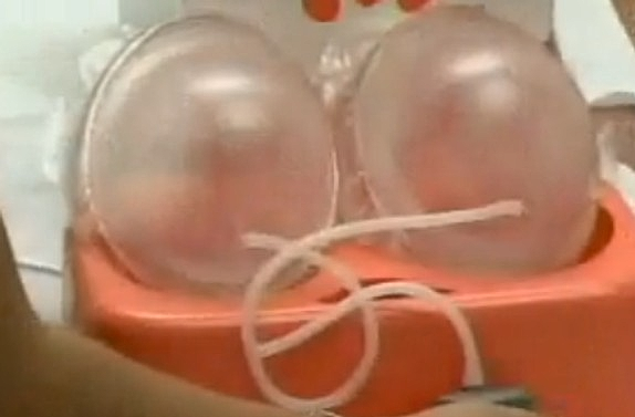 Fat Grafting for Breast Enlargement/Augmentation