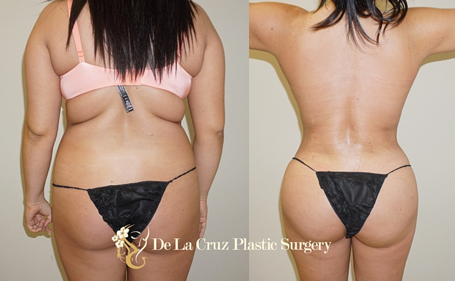 History of Liposuction