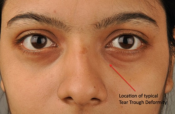 Hyaluronic Acid Injections for Tear Trough Deformities