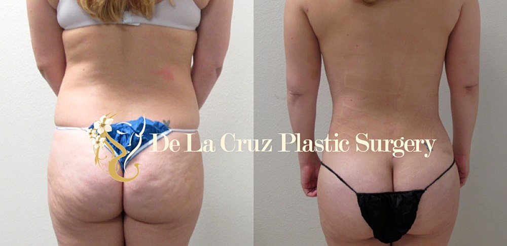 Large Volume Liposuction Improves Cholesterol Level and Diabetes