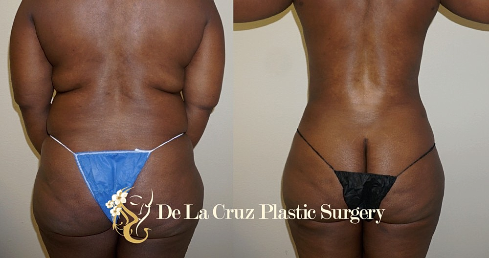 Large Volume Liposuction may Improve Diabetes & Hypertension