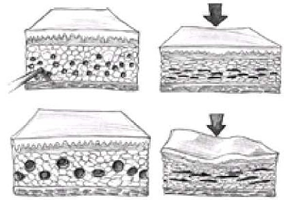 Reducing Risk of Contour/Skin Irregularities after Liposuction