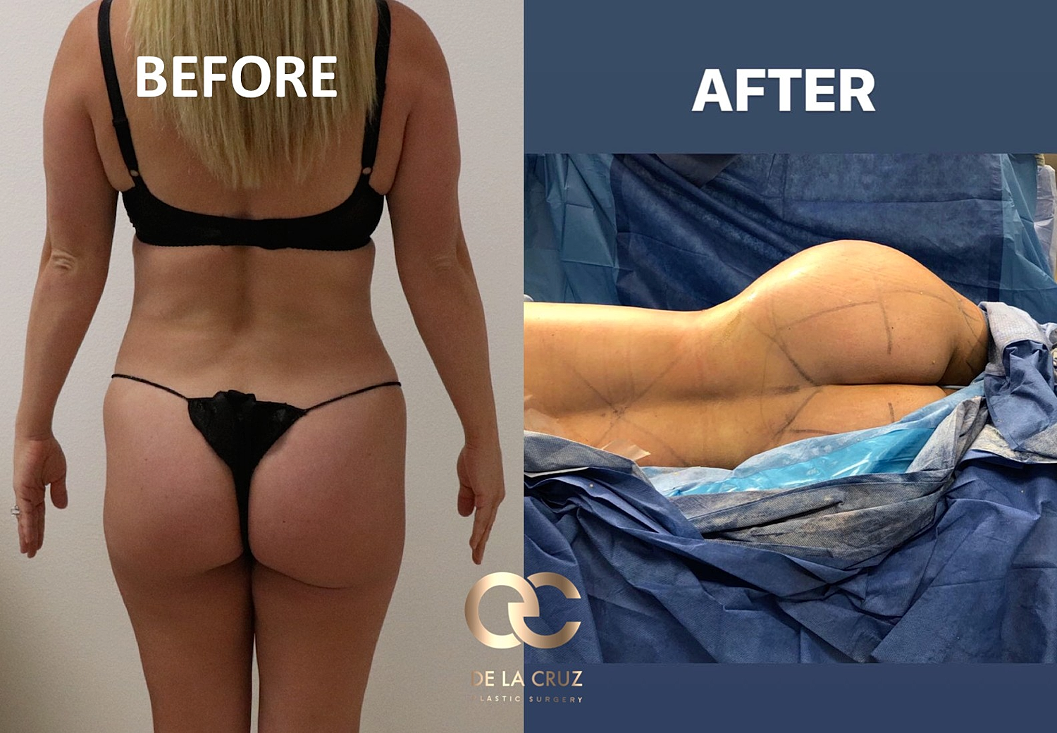 Safety in Brazilian Butt Lift Surgery