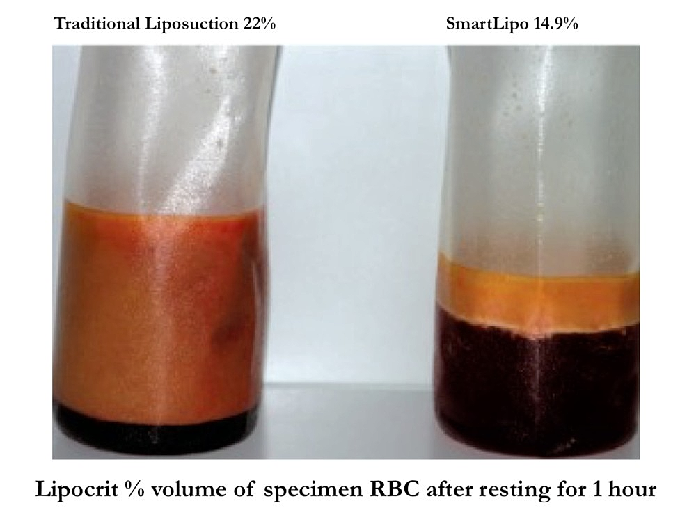 SmartLipo versus Traditional Tumescent Liposuction - Houston, Texas