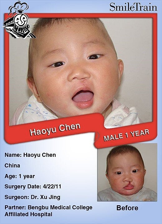 Smile Train China & Operation Smile Vietnam