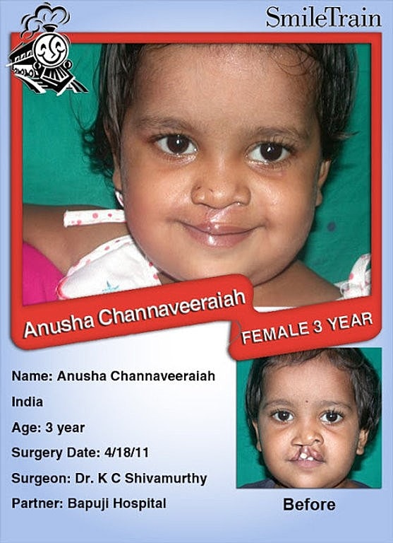 Smile Train July 2011 ~ India