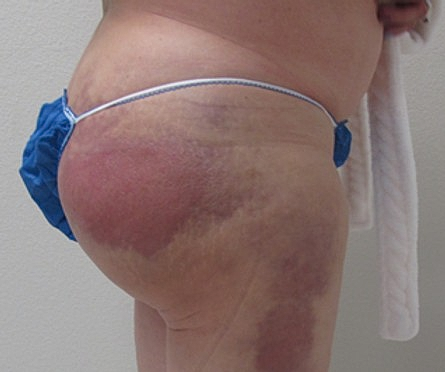 Tratamiento de Biopolímeros / Inyecciones de Hidrogel para Glúteos