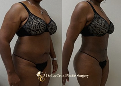 VASER LIPOSUCTION HOUSTON TEXAS