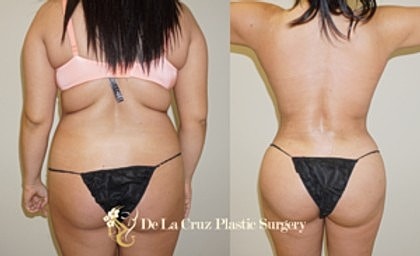 Before and after plastic surgery results.