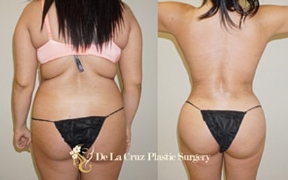 Before and after body enhancement comparison