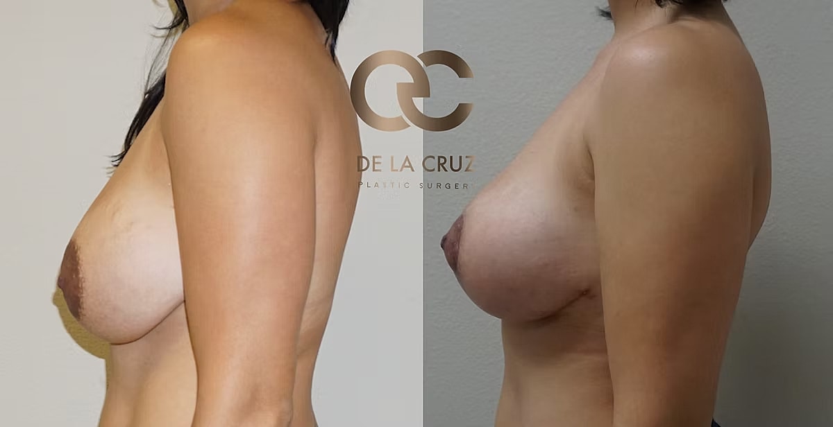 Before and after breast augmentation comparison image.
