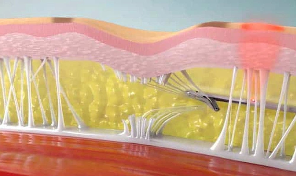 Cross-section of skin layers and underlying tissue.