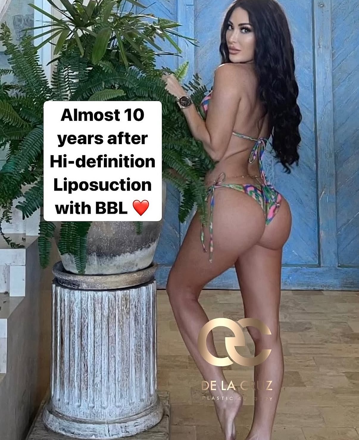 Model showing results after liposuction and BBL.