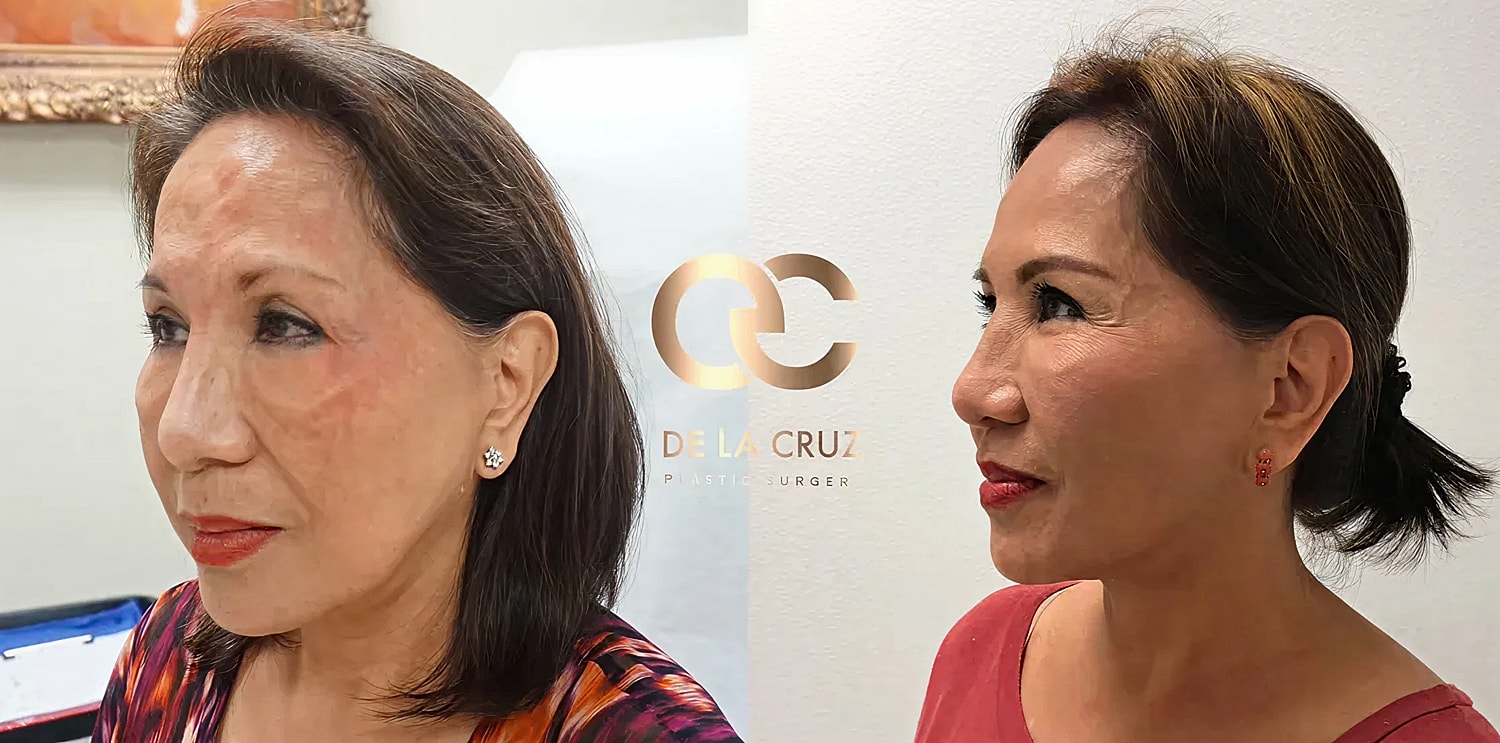 Best scarless facelift houston facetite