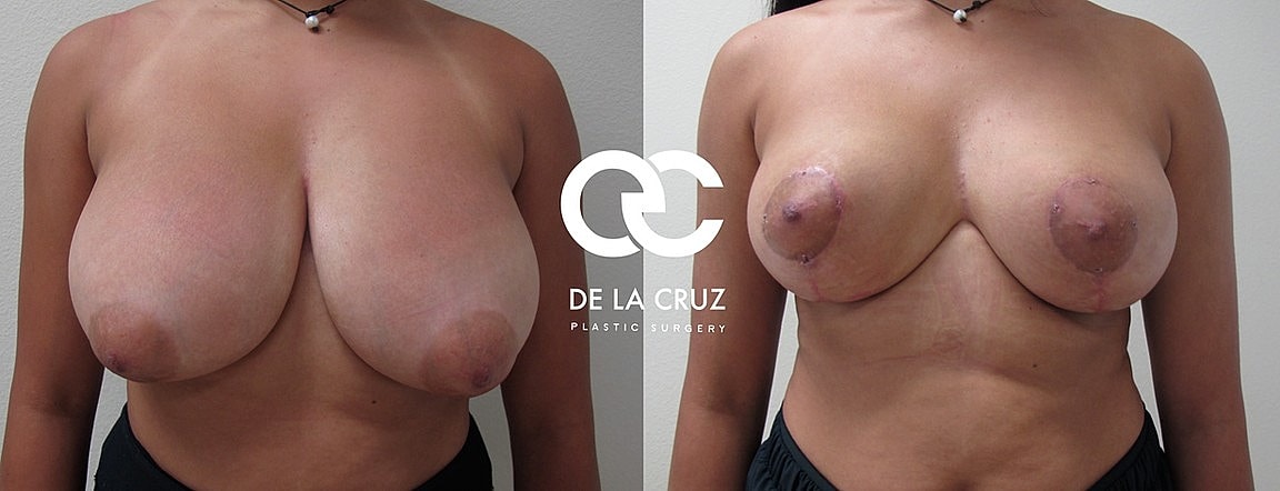 Before and after breast surgery comparison image.