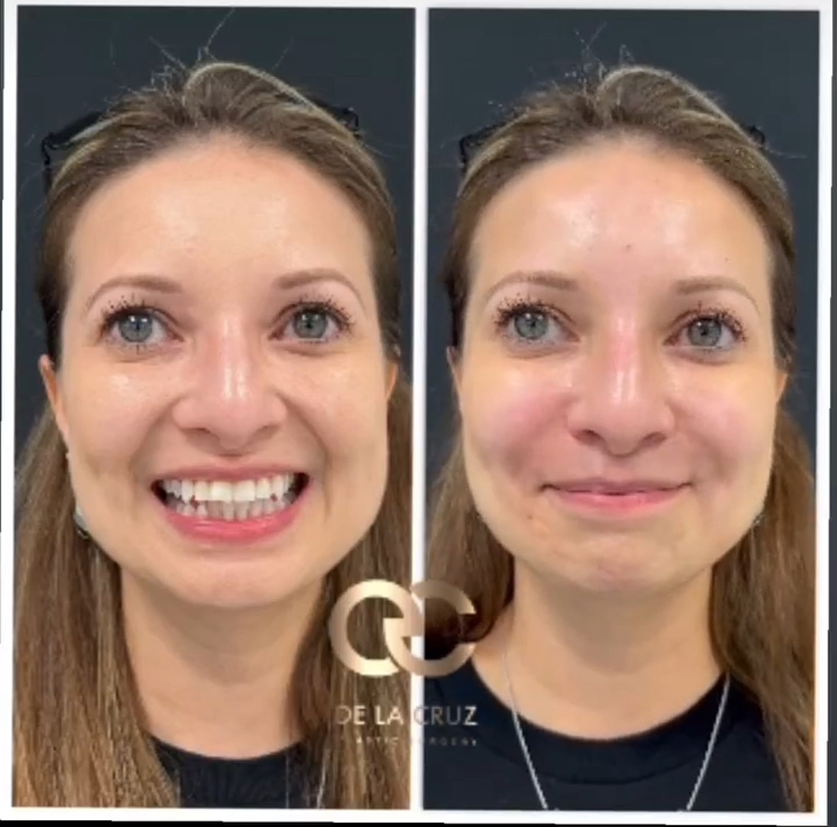 Before and after dermal filler treatment transformation.