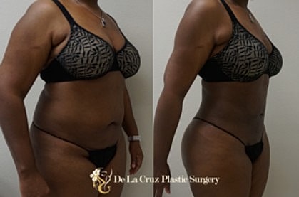 Before and after body side profile comparison