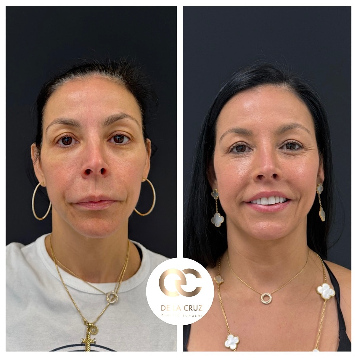 Before and after cosmetic surgery transformation.