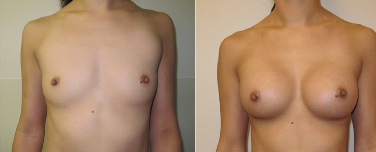 Breast Augmentation Before & After