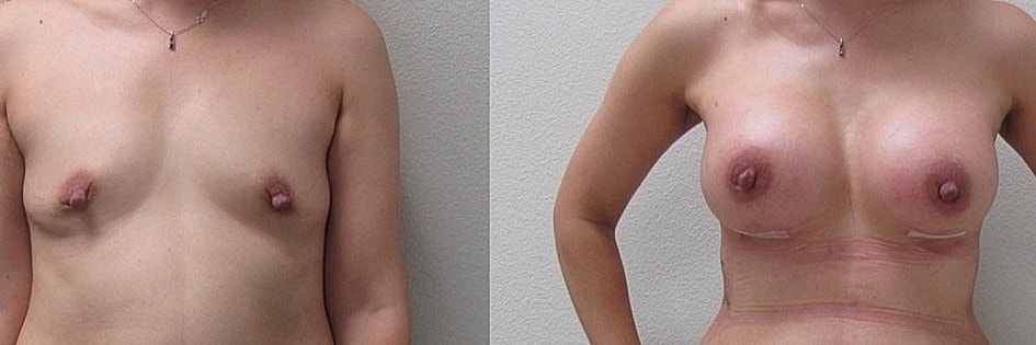 Breast Augmentation Before & After