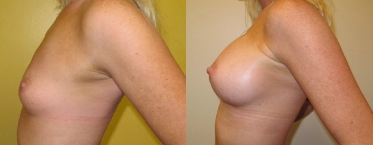 Breast Augmentation Before & After