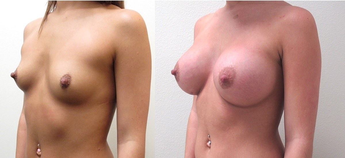 Breast Augmentation Before & After