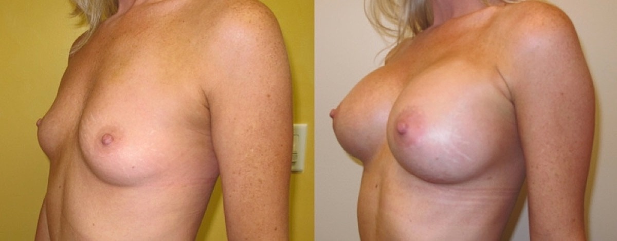 Breast Augmentation Before & After