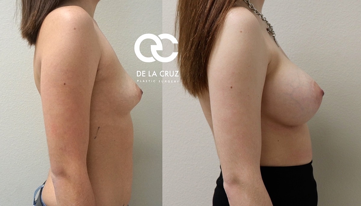 Breast Augmentation Before & After
