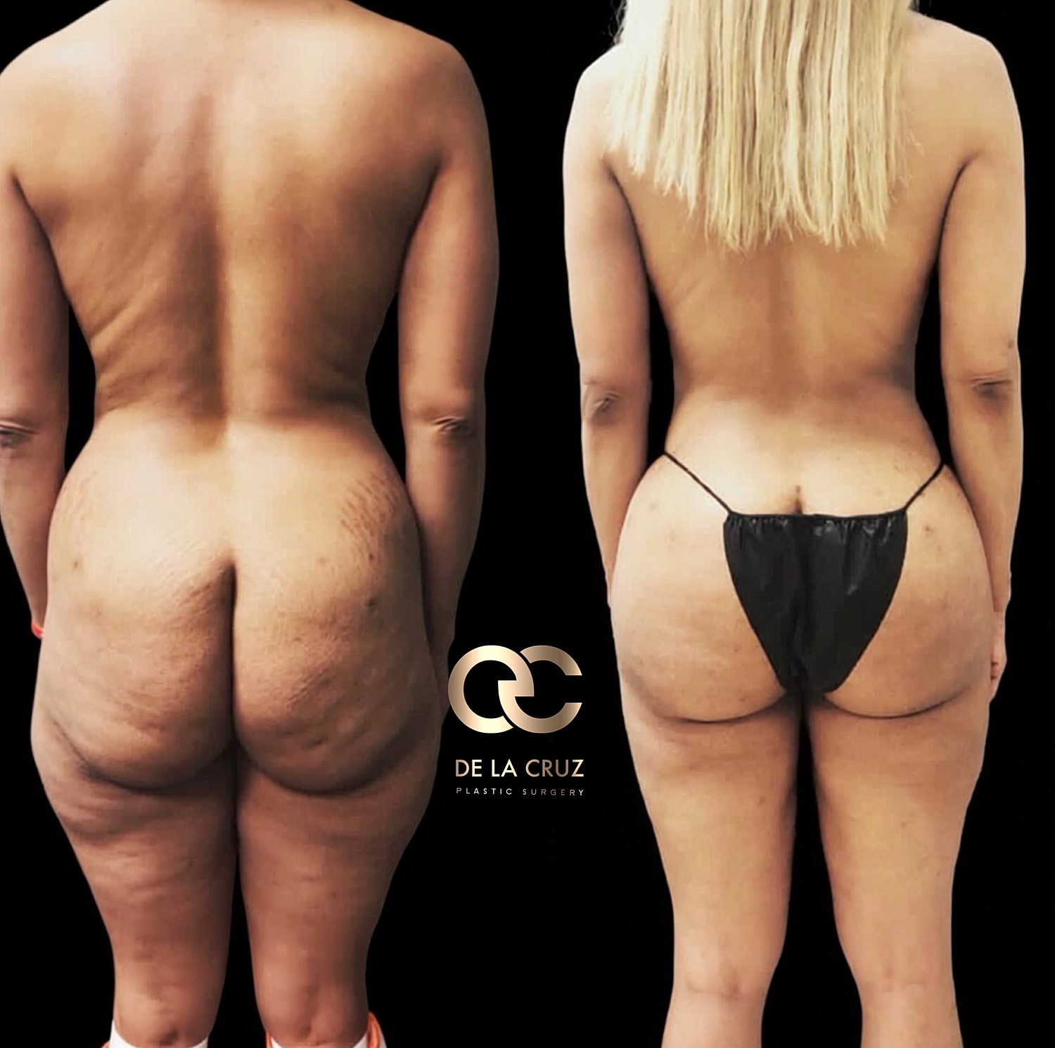 Before and after Liposuction of the back with buttock reshaping