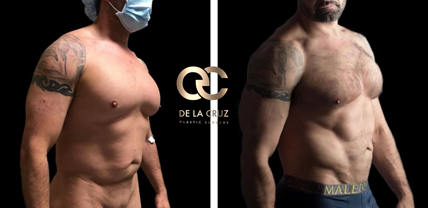 Before and after male High-Definition Liposuction with abdominal etching