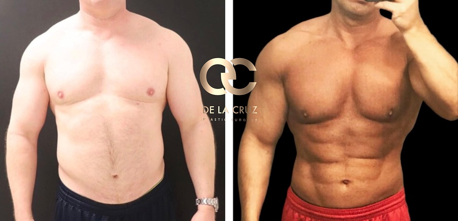 Before and after High-definition liposuction in men with abdominal etching
