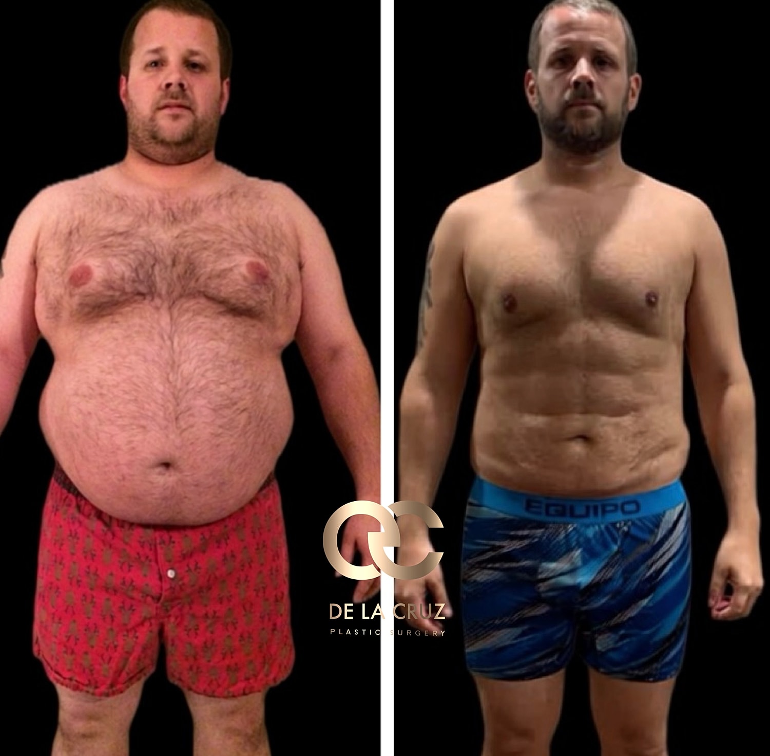 Before and after large volume liposuction 