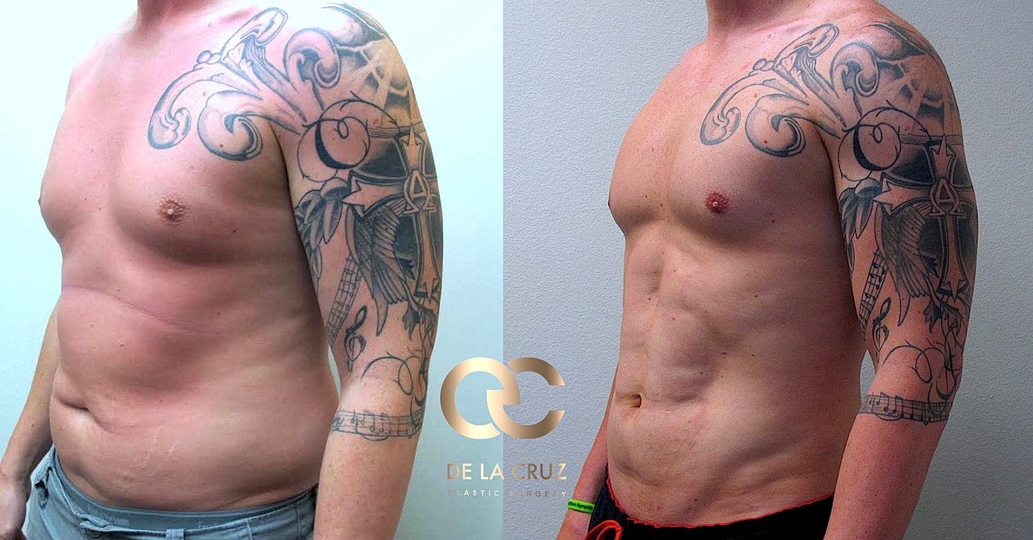 Before and after High-definition liposuction of male with abdominal etching