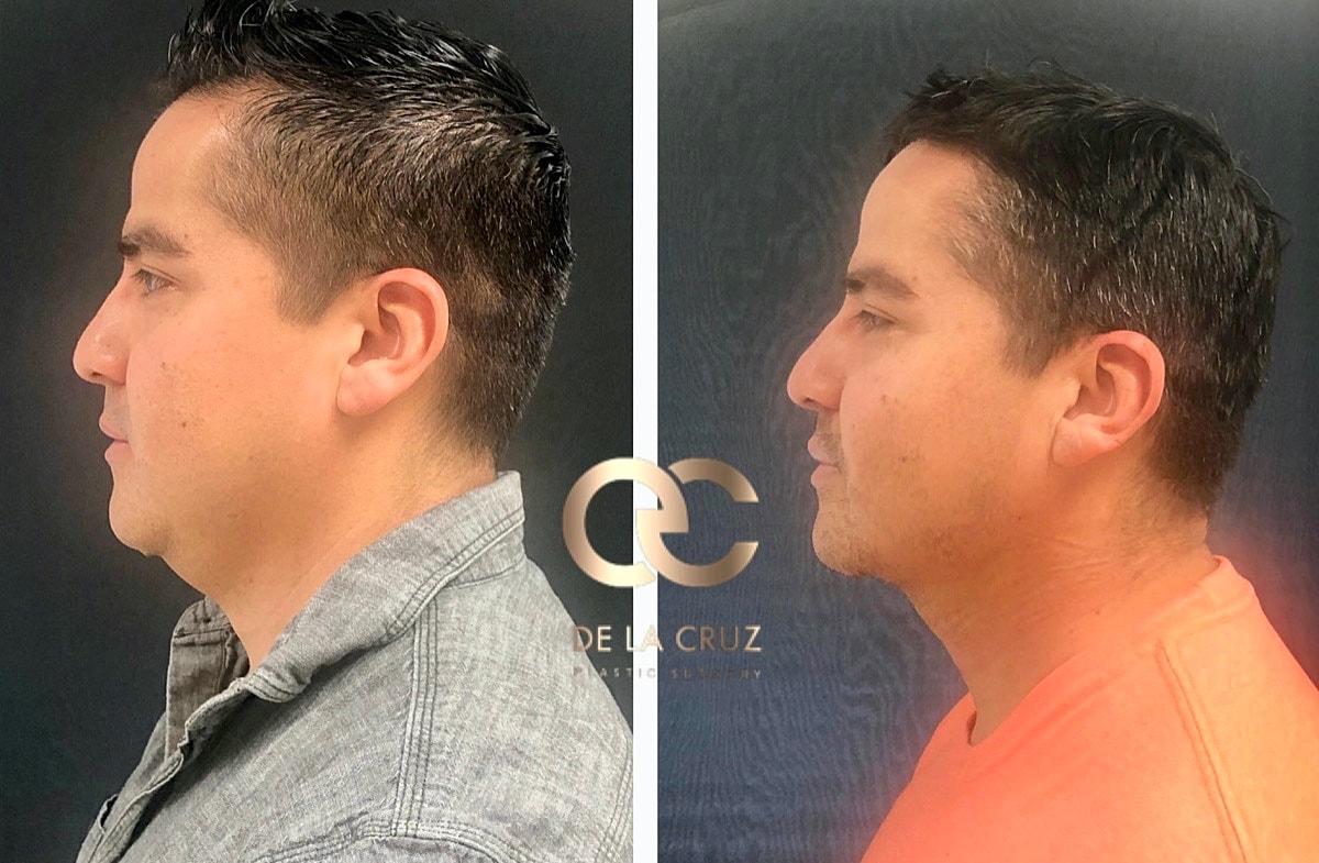 Necktite Before & After