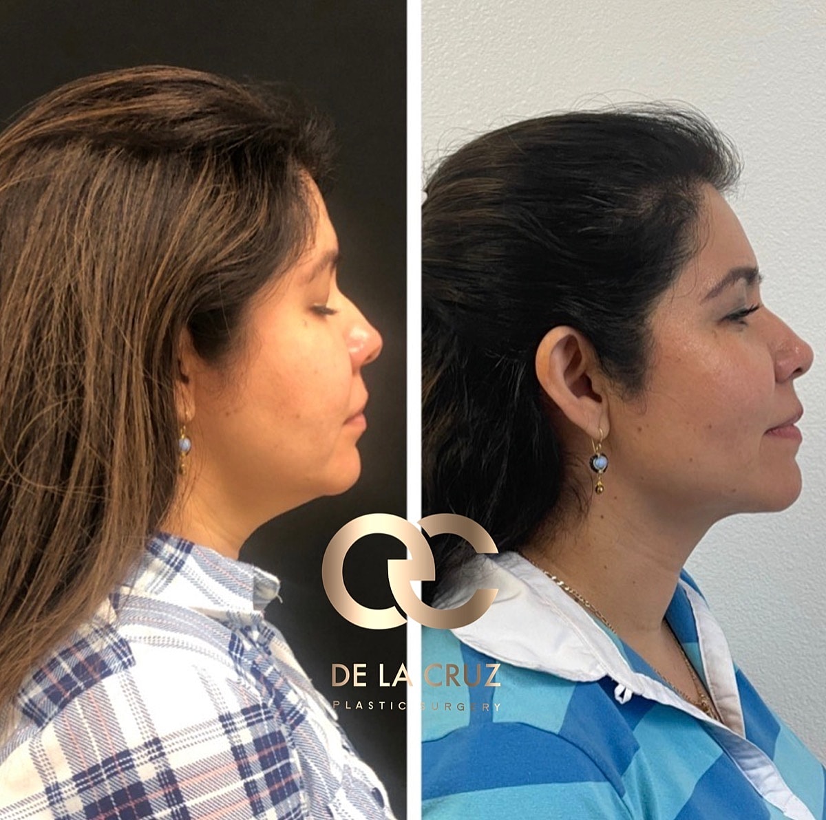 Necktite Before & After