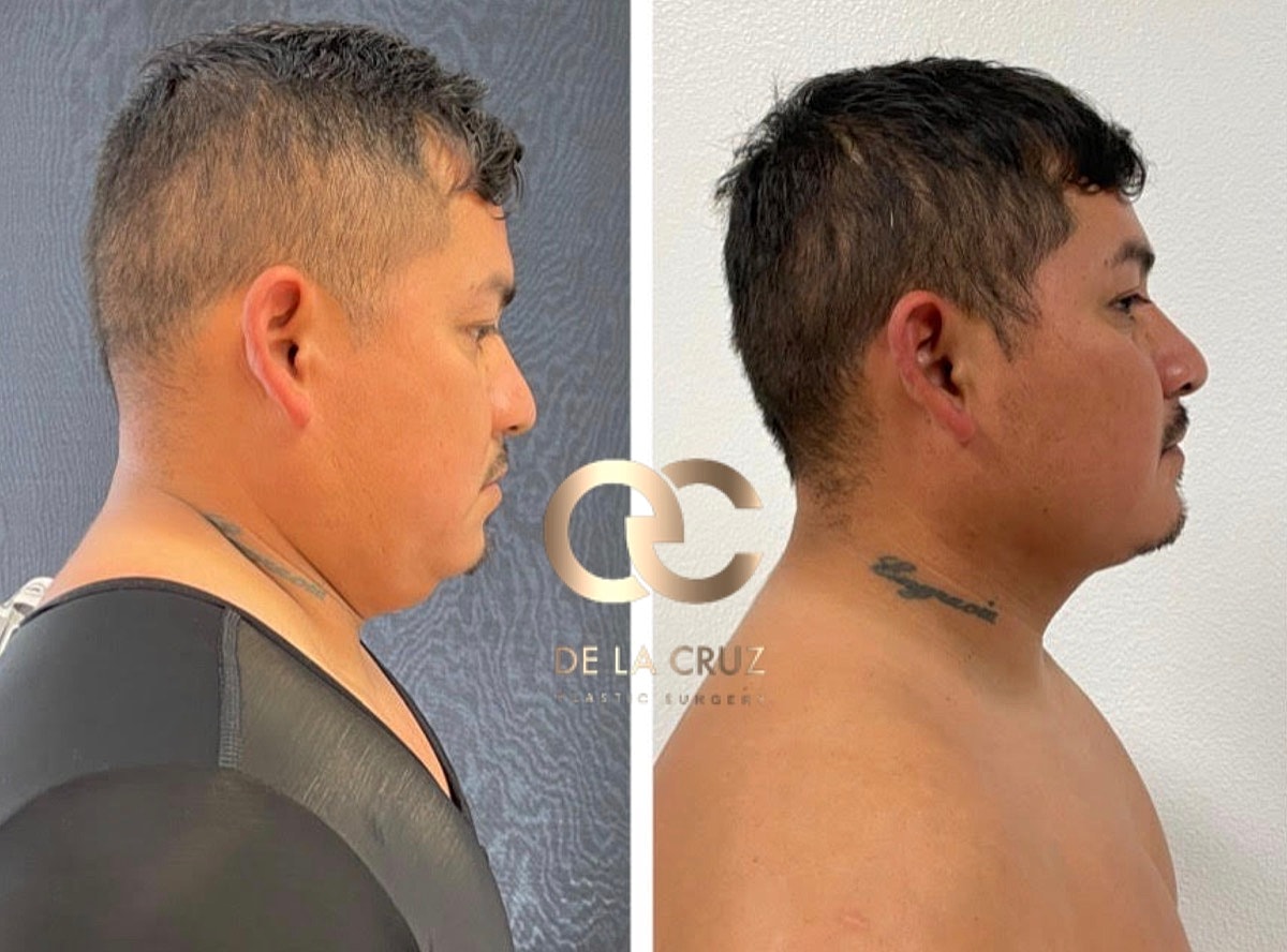 Necktite Before & After