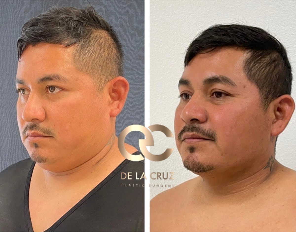 Necktite Before & After