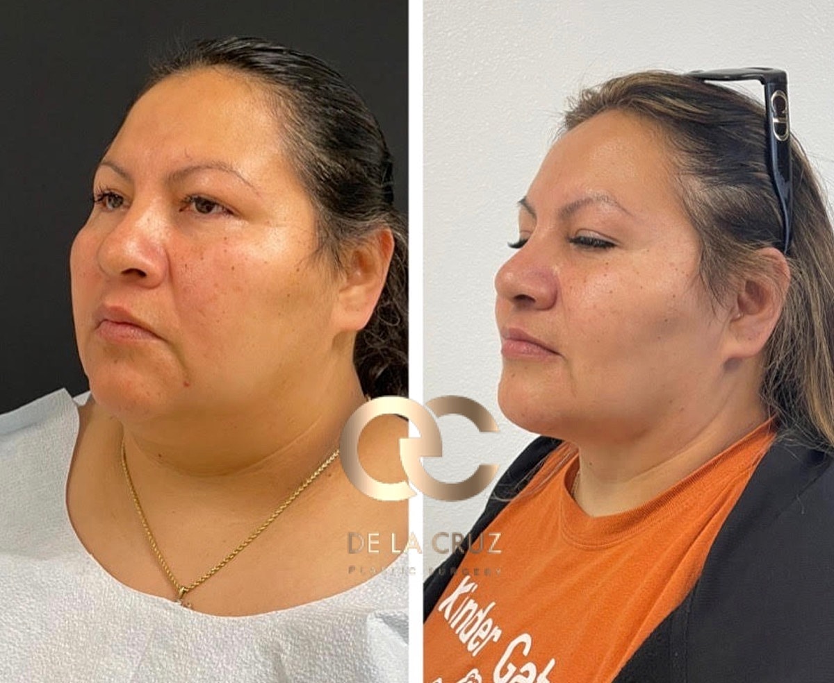 Necktite Before & After