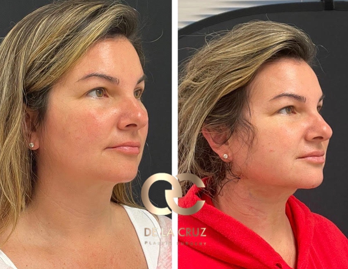 Necktite Before & After