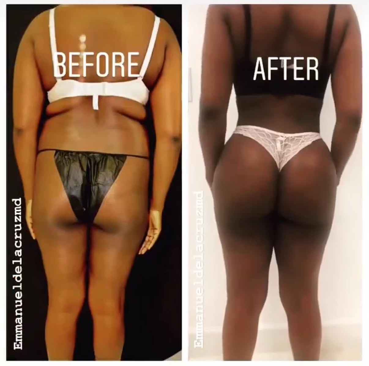 BBL results Houston fat transfer buttocks