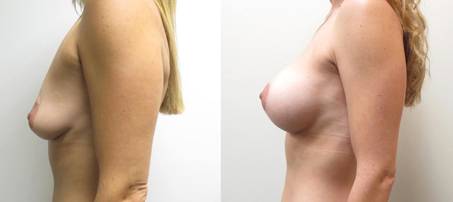 breast implant results Houston plastic surgeon