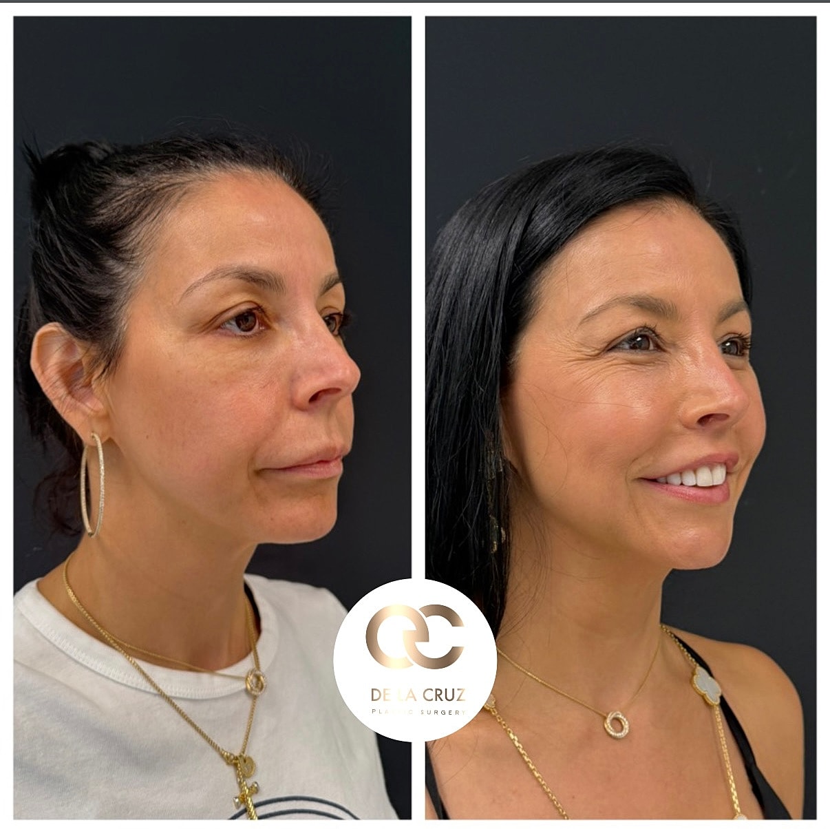 facelift results Houston plastic surgeon