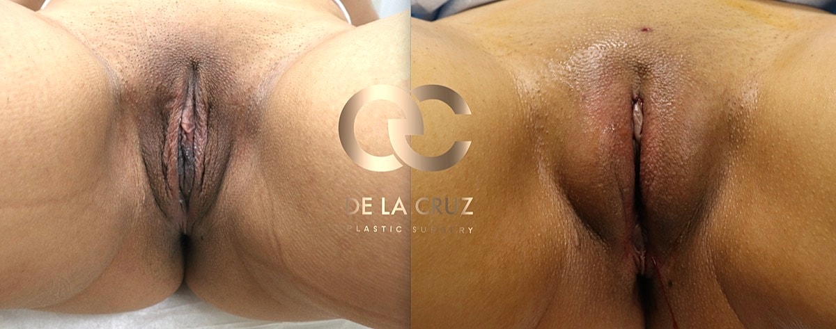 Labiaplasty Before & After