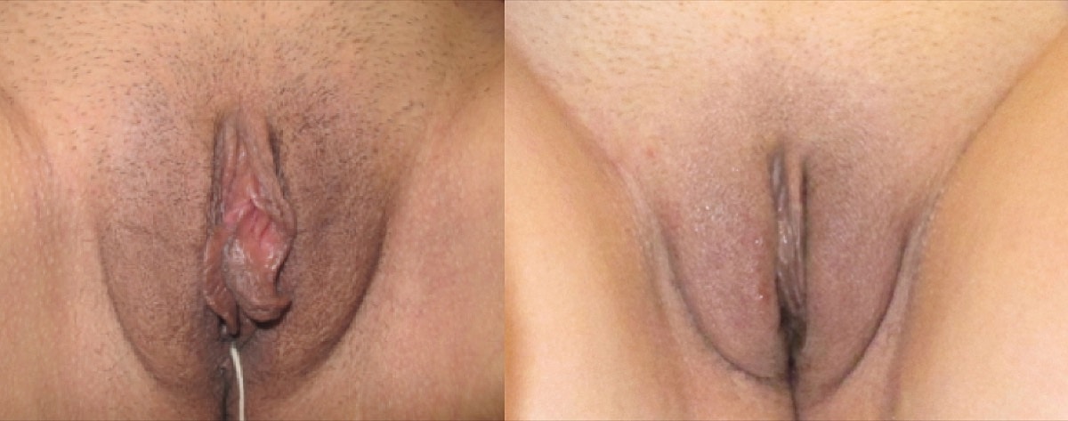 Labiaplasty Before & After
